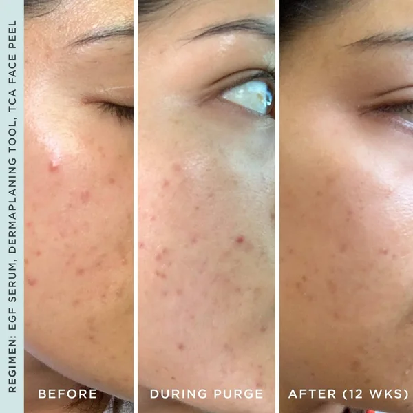 Gentle Chemical TCA Peel Facial Exfoliating Treatment - StackedSkincare, Mini Deluxe (10ml)